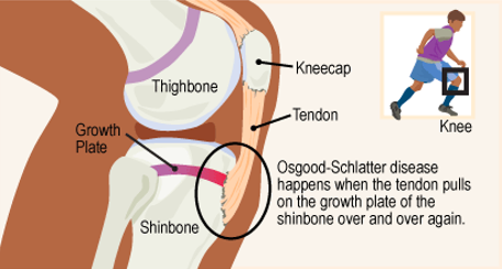 Osgood-Schlatter Disease