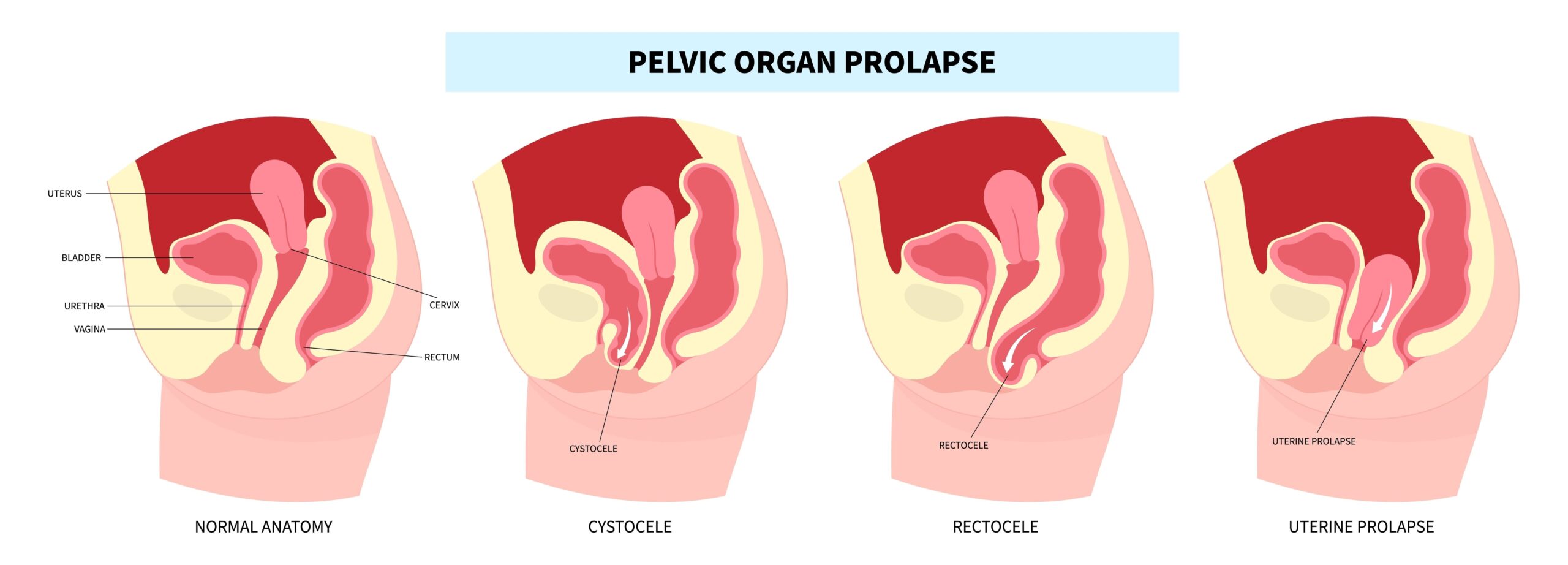 Pelvic Organ Prolapse