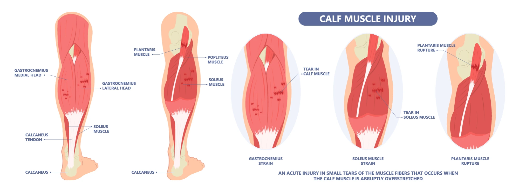 Understanding Calf Tears