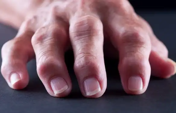 Focus on the Hand and Osteoarthritis