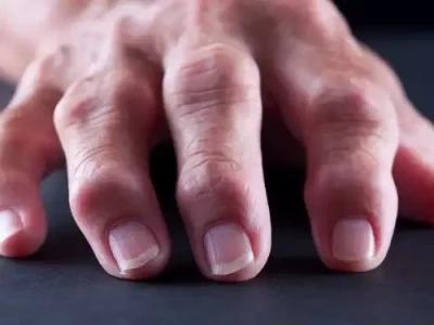 Focus on the Hand and Osteoarthritis